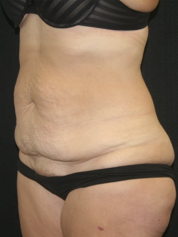 Tummy Tuck Before & After Gallery - Patient 120948243 - Image 3