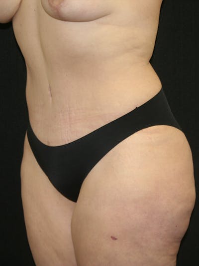 Tummy Tuck Before & After Gallery - Patient 120948243 - Image 4