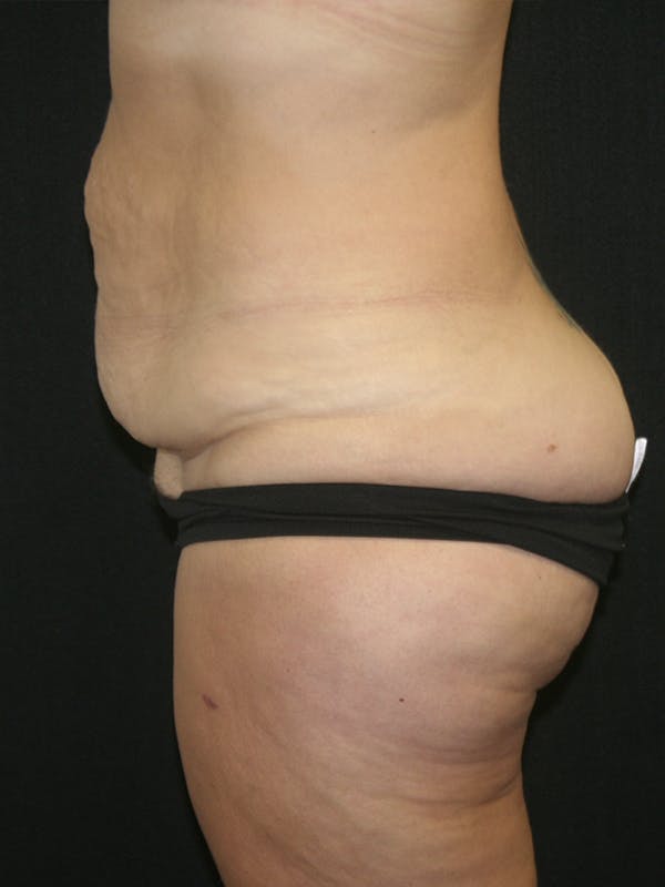 Tummy Tuck Before & After Gallery - Patient 120948243 - Image 5