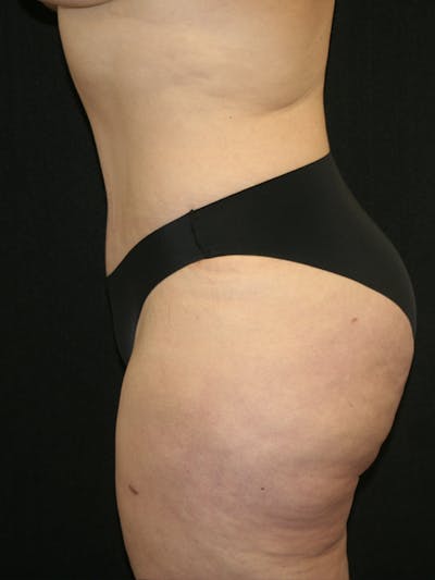 Tummy Tuck Before & After Gallery - Patient 120948243 - Image 6