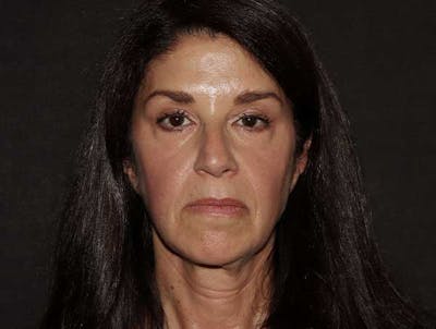 Botox Before & After Gallery - Patient 121416613 - Image 1