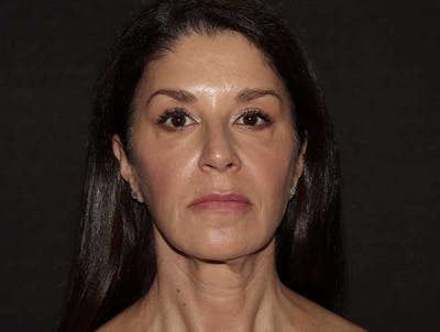 Botox Before & After Gallery - Patient 121416613 - Image 2