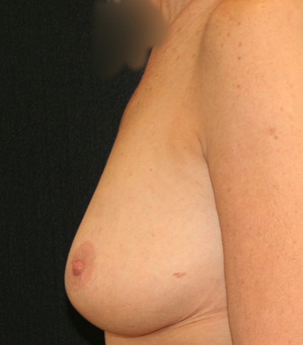 Breast Augmentation Before & After Gallery - Patient 123862110 - Image 5