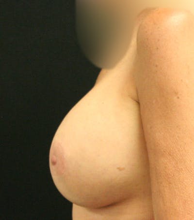 Breast Augmentation Before & After Gallery - Patient 123862110 - Image 6