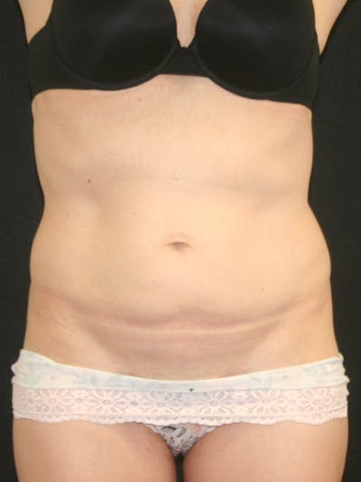 Tummy Tuck Before & After Gallery - Patient 142880897 - Image 1