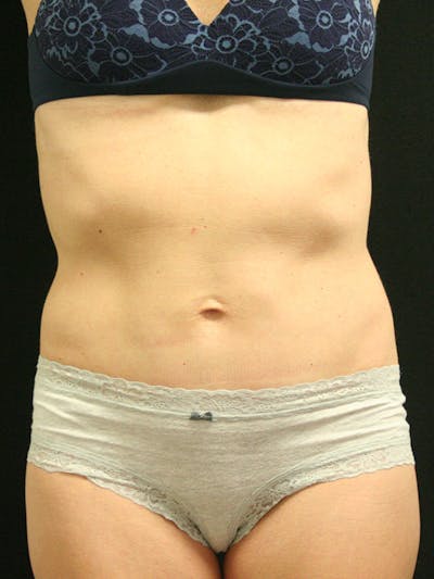 Tummy Tuck Before & After Gallery - Patient 142880897 - Image 2