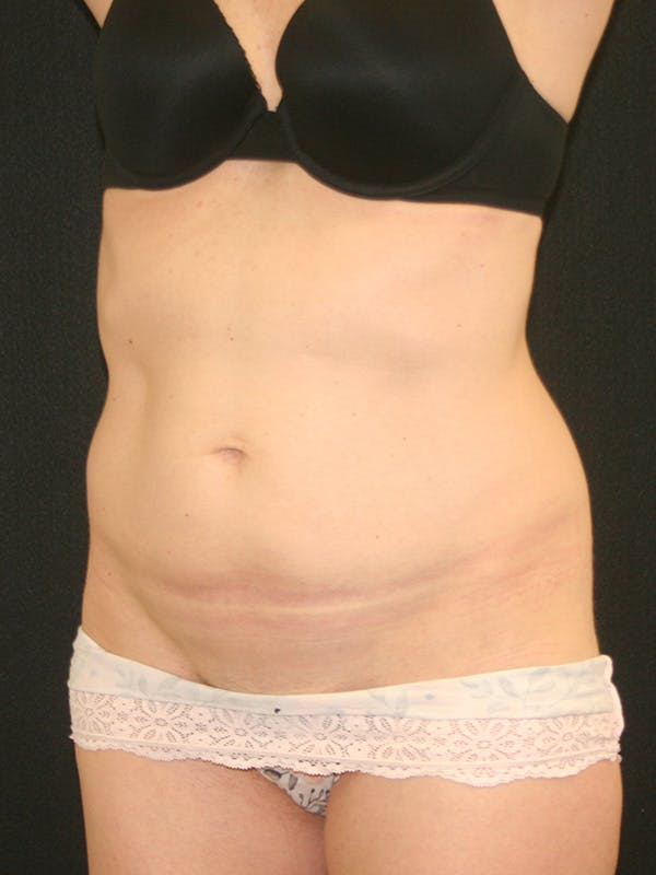 Tummy Tuck Before & After Gallery - Patient 142880897 - Image 3
