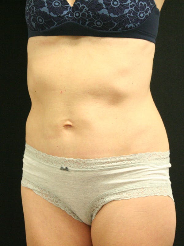 Tummy Tuck Before & After Gallery - Patient 142880897 - Image 4