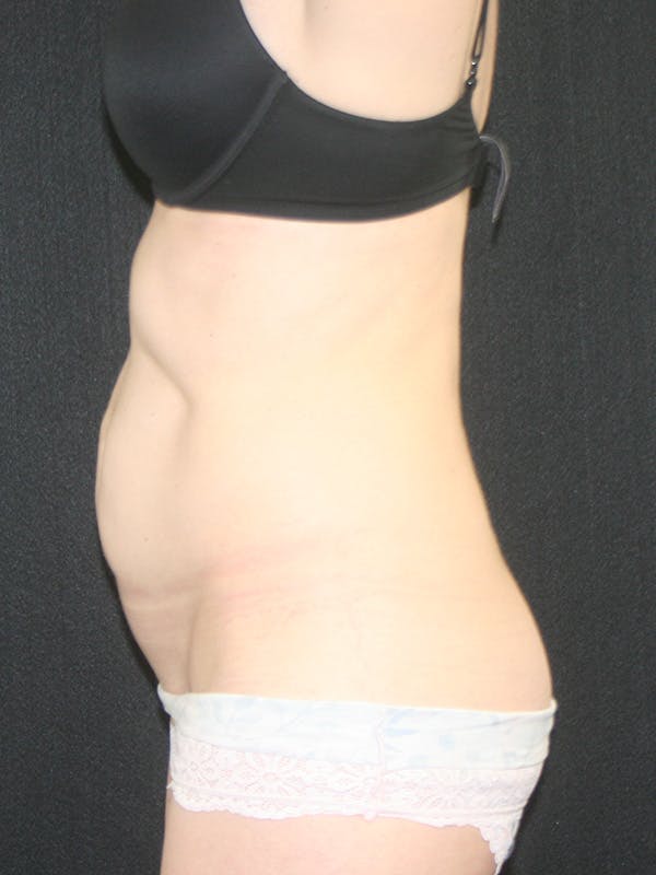 Tummy Tuck Before & After Gallery - Patient 142880897 - Image 5