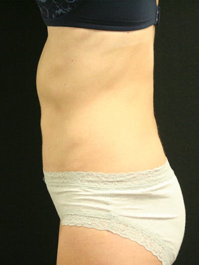 Tummy Tuck Before & After Gallery - Patient 142880897 - Image 6