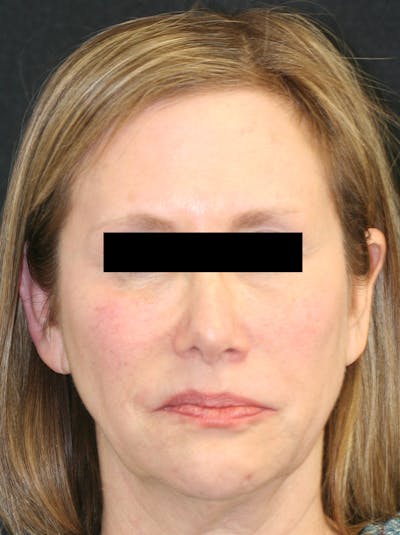 Facelift Before & After Gallery - Patient 142899044 - Image 1