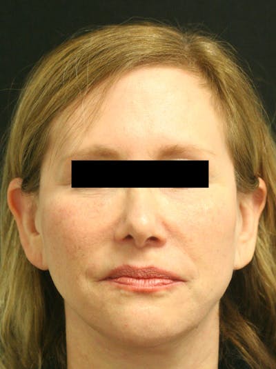 Facelift Before & After Gallery - Patient 142899044 - Image 2