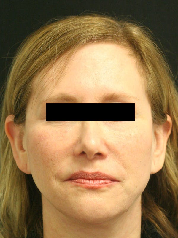 Facelift Before & After Gallery - Patient 142899044 - Image 2