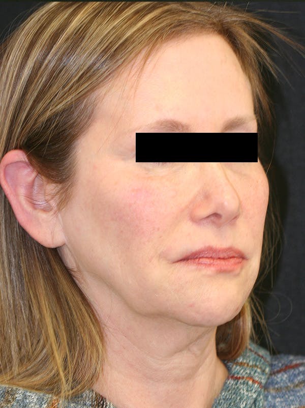 Facelift Before & After Gallery - Patient 142899044 - Image 3