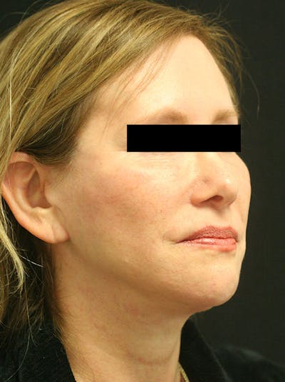 Facelift Before & After Gallery - Patient 142899044 - Image 4