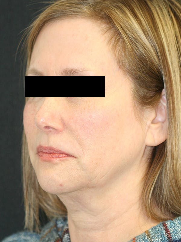 Facelift Before & After Gallery - Patient 142899044 - Image 5