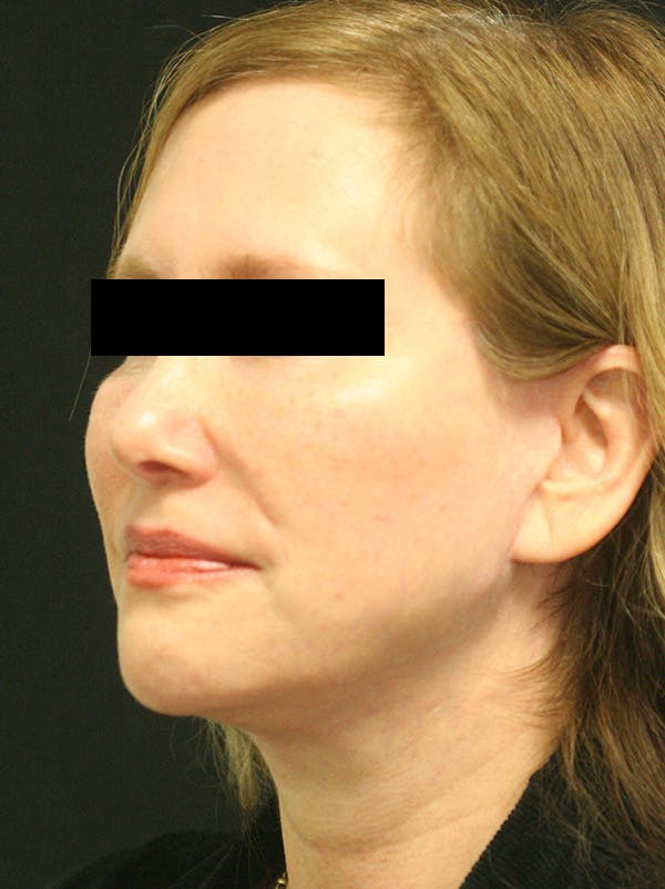 Facelift Before & After Gallery - Patient 142899044 - Image 6