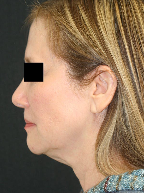 Facelift Before & After Gallery - Patient 142899044 - Image 7
