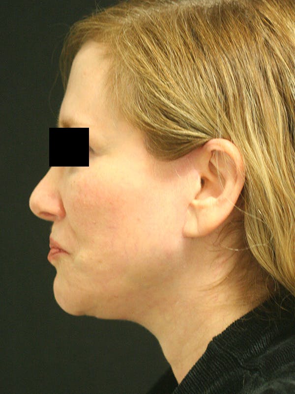 Facelift Before & After Gallery - Patient 142899044 - Image 8