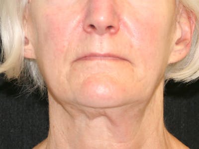 Facelift Before & After Gallery - Patient 142899046 - Image 1