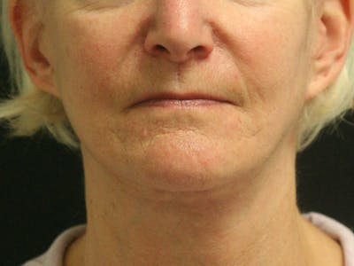 Facelift Before & After Gallery - Patient 142899046 - Image 2