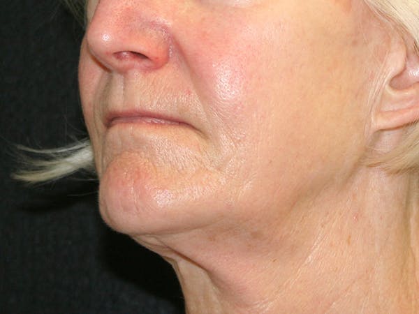Facelift Before & After Gallery - Patient 142899046 - Image 3