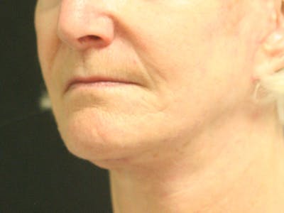 Facelift Before & After Gallery - Patient 142899046 - Image 4