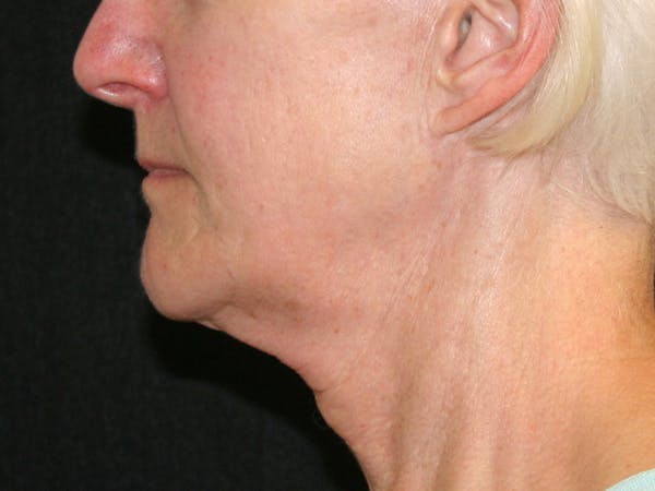 Facelift Before & After Gallery - Patient 142899046 - Image 5