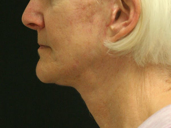 Facelift Before & After Gallery - Patient 142899046 - Image 6