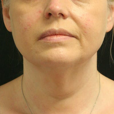 Facetite Before & After Gallery - Patient 142899061 - Image 1