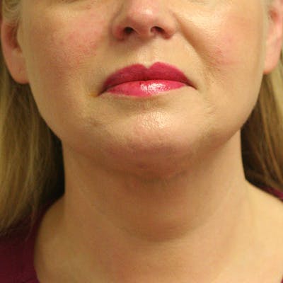 Facetite Before & After Gallery - Patient 142899061 - Image 2