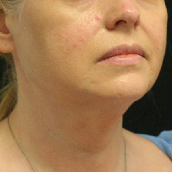 Facetite Before & After Gallery - Patient 142899061 - Image 3