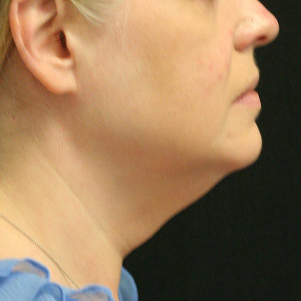 Facetite Before & After Gallery - Patient 142899061 - Image 5