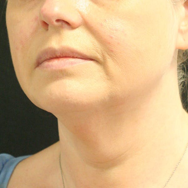 Facetite Before & After Gallery - Patient 142899061 - Image 7