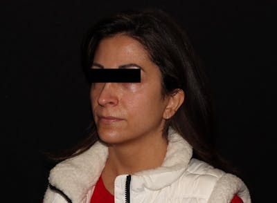 Exilis Ultra Before & After Gallery - Patient 144636949 - Image 1