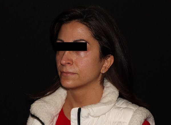 Exilis Ultra Before & After Gallery - Patient 144636949 - Image 1