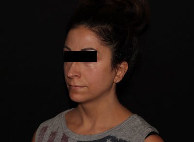 Exilis Ultra Before & After Gallery - Patient 144636949 - Image 2
