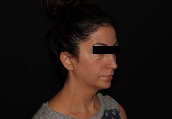 Exilis Ultra Before & After Gallery - Patient 144636949 - Image 4