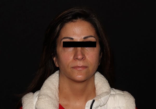 Exilis Ultra Before & After Gallery - Patient 144636949 - Image 5