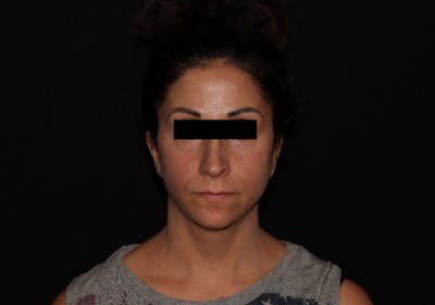 Exilis Ultra Before & After Gallery - Patient 144636949 - Image 6