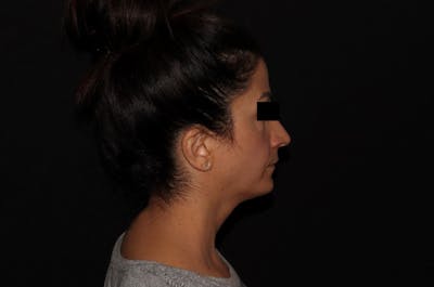 Exilis Ultra Before & After Gallery - Patient 144636949 - Image 8