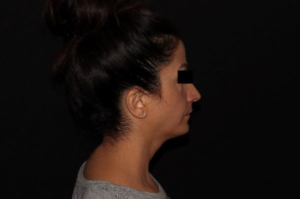 Exilis Ultra Before & After Gallery - Patient 144636949 - Image 8