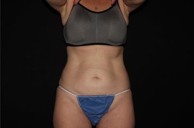 CoolSculpting® Elite Before & After Gallery - Patient 144636867 - Image 2