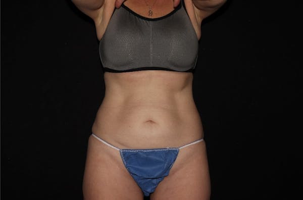 CoolSculpting® Elite Before & After Gallery - Patient 144636867 - Image 2