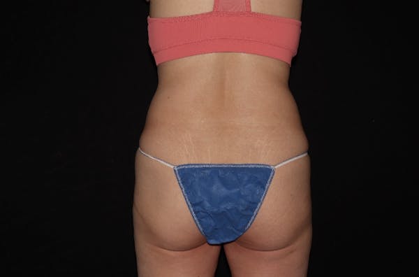 CoolSculpting® Elite Before & After Gallery - Patient 144636913 - Image 1