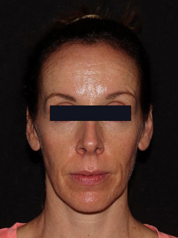 Microneedling Before & After Gallery - Patient 146131272 - Image 1