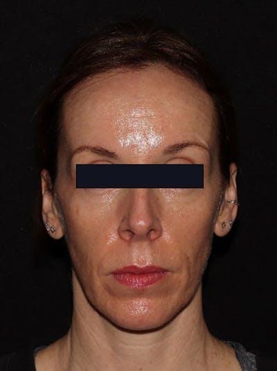 Microneedling Before & After Gallery - Patient 146131272 - Image 2