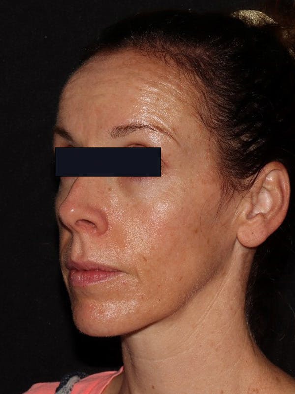 Microneedling Before & After Gallery - Patient 146131272 - Image 3