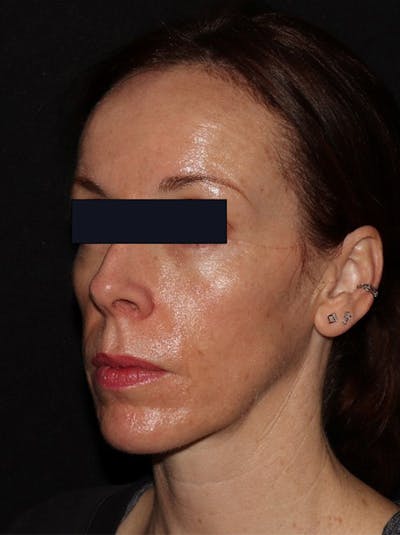 Microneedling Before & After Gallery - Patient 146131272 - Image 4