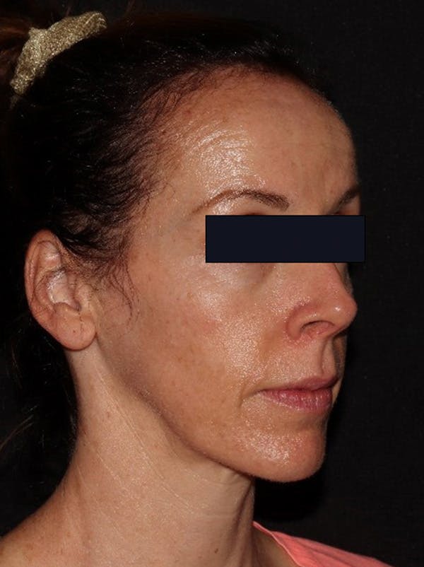 Microneedling Before & After Gallery - Patient 146131272 - Image 5